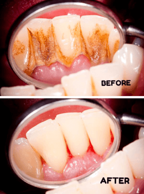 How to remove plaque deals from teeth