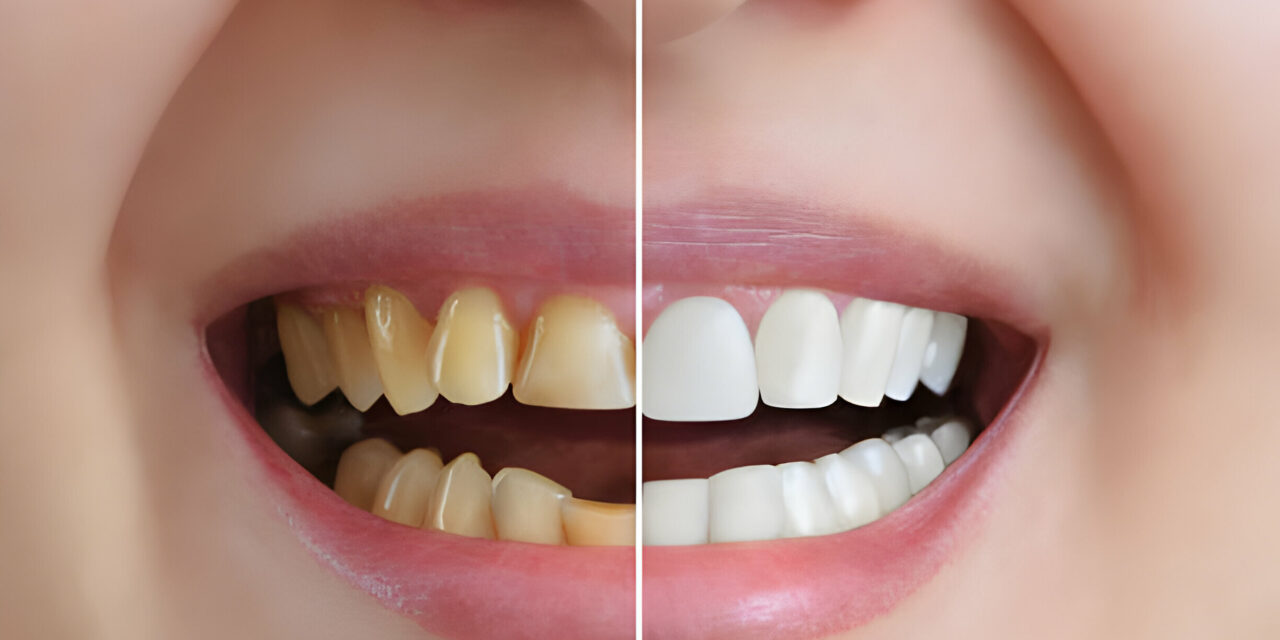 Flaunt Those Pearly Whites: Expert Tips for Effective Teeth Whitening