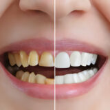 Flaunt Those Pearly Whites: Expert Tips for Effective Teeth Whitening_FI