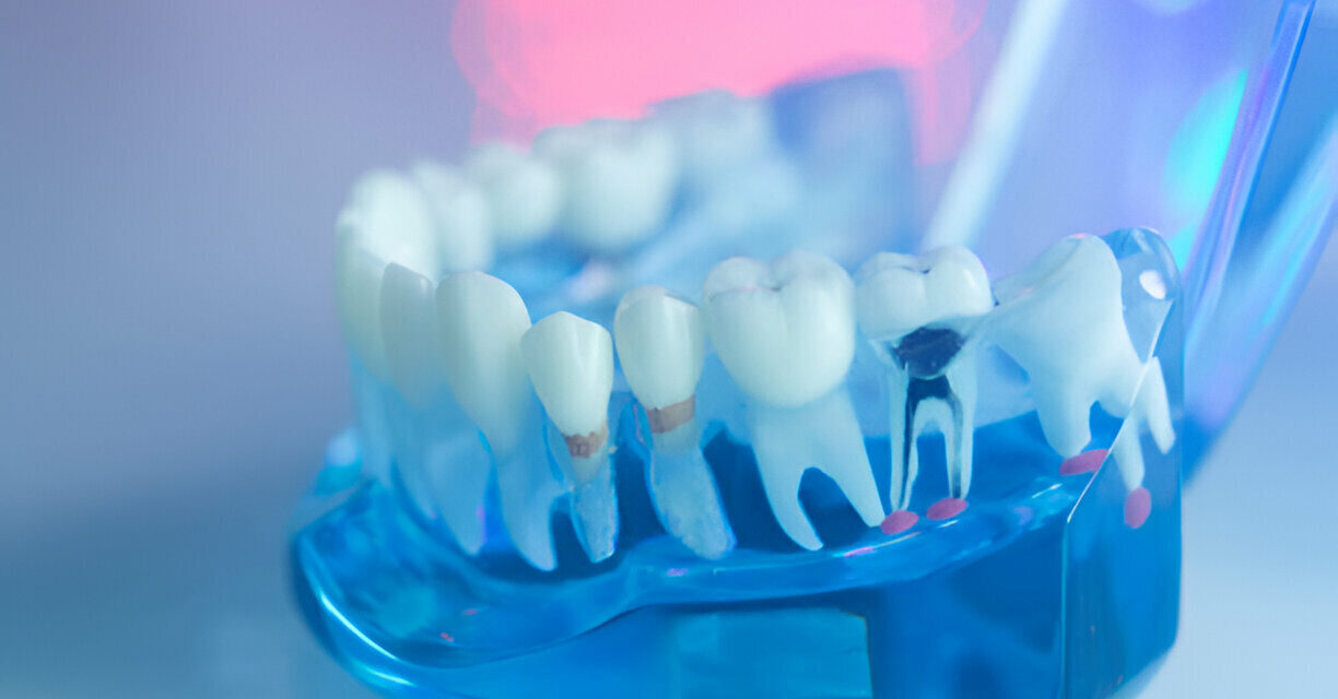 Signs You Might Need a Root Canal and What to Do Next